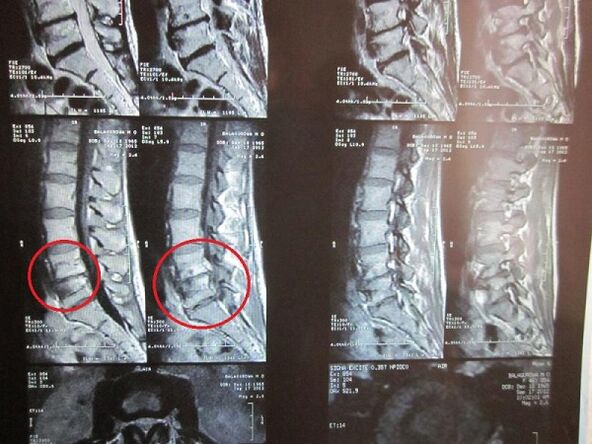 Diagnose einer zervikalen Osteochondrose