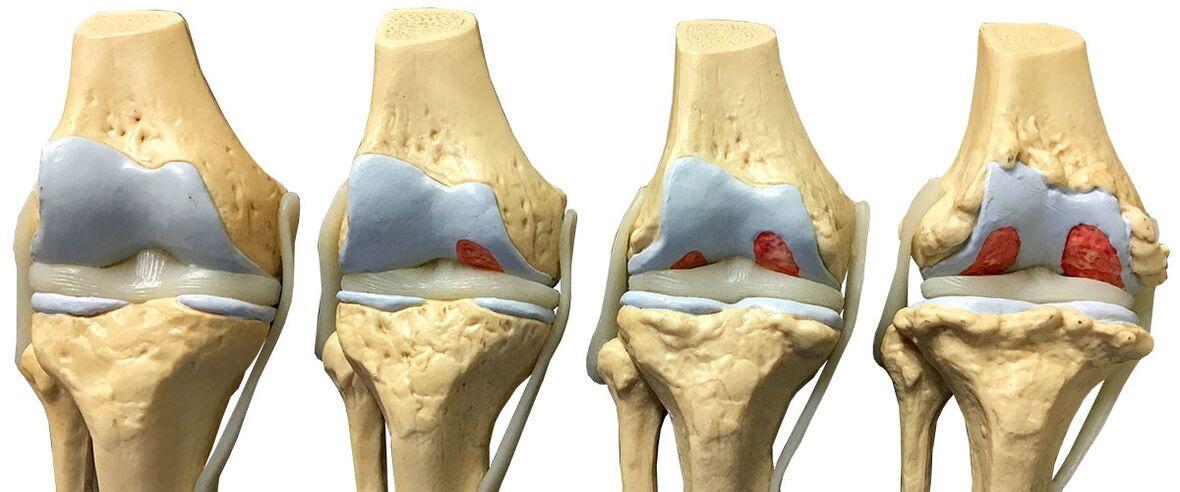 Arthrosestadien
